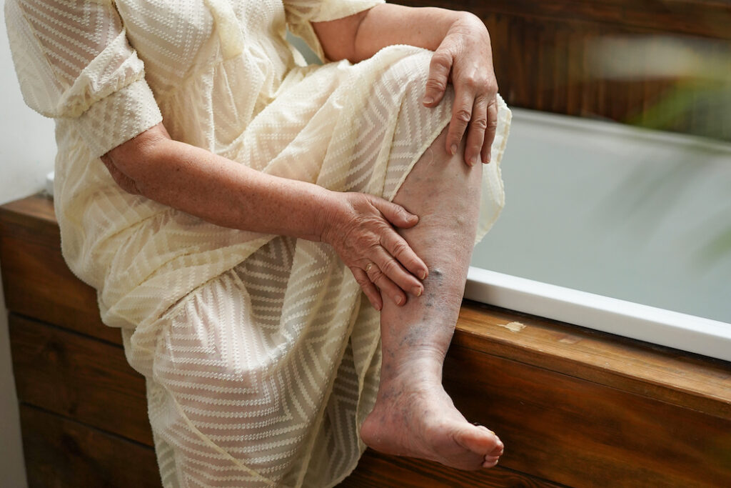 Managing Varicose Veins – Tips That Exclude Surgery