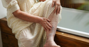 Managing Varicose Veins – Tips That Exclude Surgery