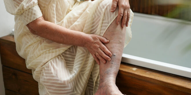 Managing Varicose Veins – Tips That Exclude Surgery