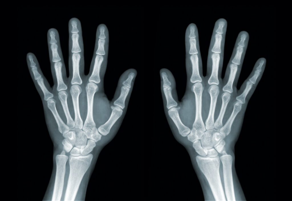 Rheumatoid Arthritis vs Osteoarthritis