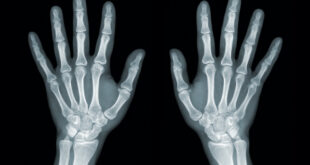 Rheumatoid Arthritis vs Osteoarthritis